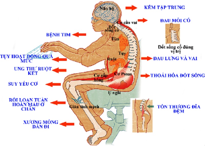 Một số bệnh lý dân văn phòng dễ mắc phải 